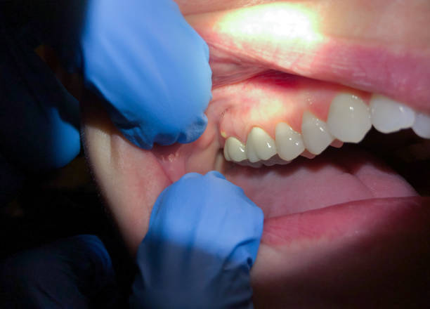 Best Emergency Dental Care for Broken or Chipped Teeth in West Mountain, UT