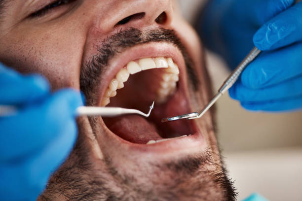 Best Emergency Tooth Extraction in West Mountain, UT